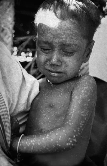 1975 – Three-year-old Rahima Banu becomes the last known case of naturally occurring smallpox