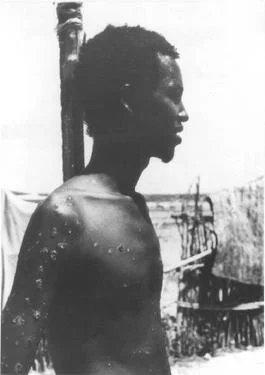 1977 – Smallpox Eradication Milestone